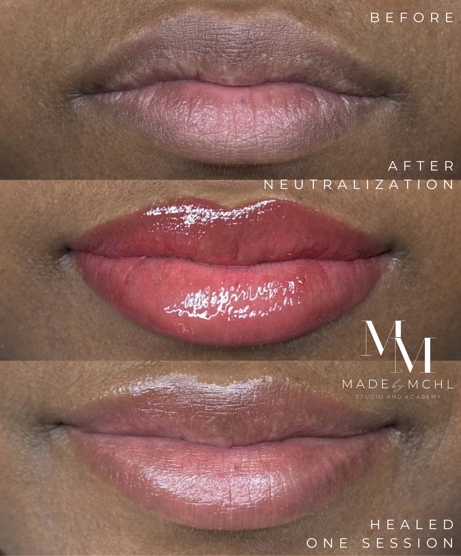 Before, after neutralization and healed one session lip result
