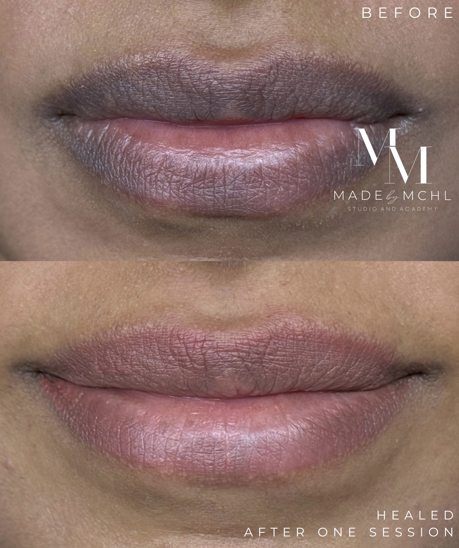 Lip neutralization before and healed after one session at MADEBYMCHL