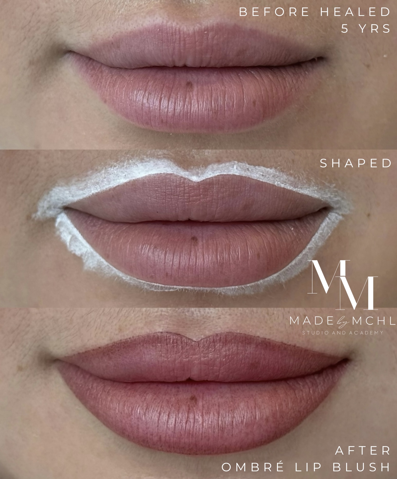 Five year healed lips reshaped and refreshed with ombré lip blush