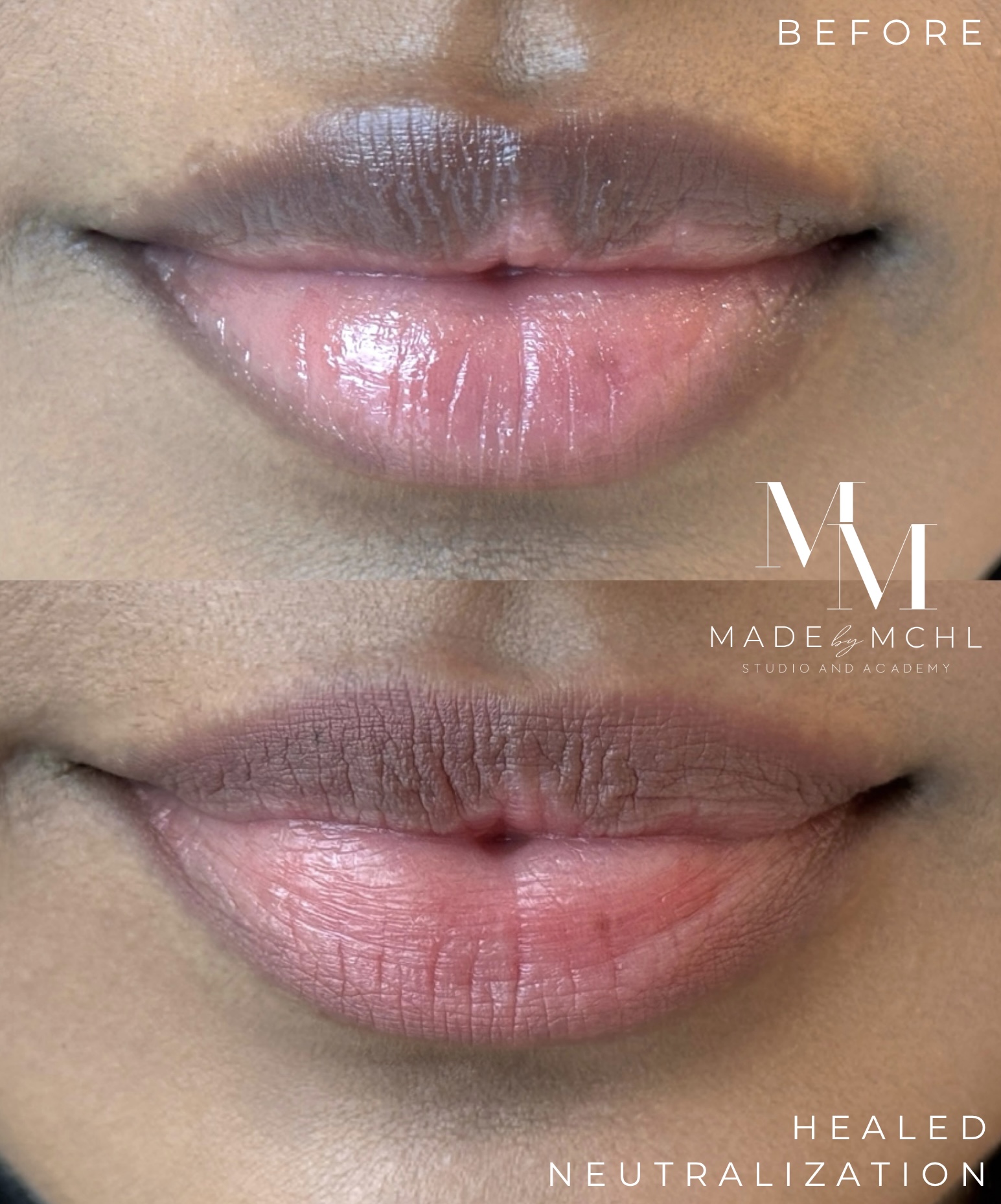 Lip neutralization result with corrected even tone