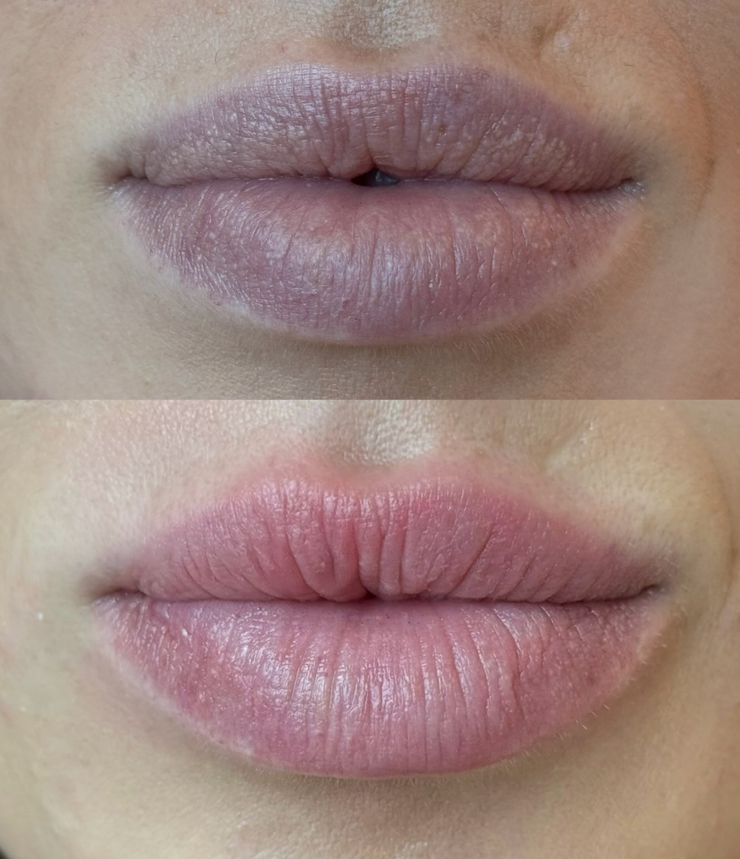 Dark lips before and healed soft pink result after neutralization